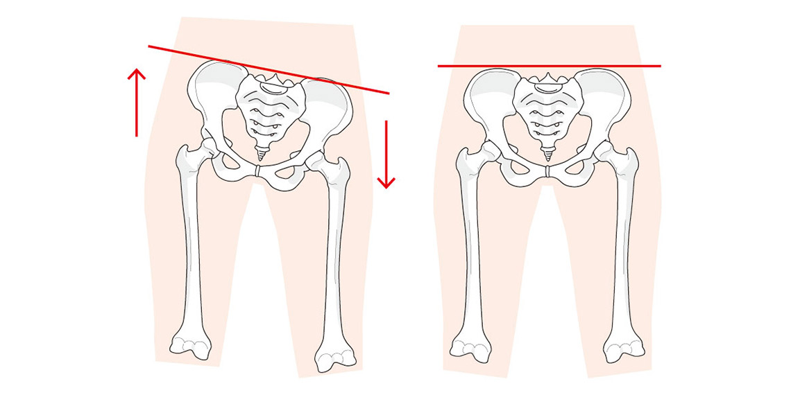 骨盤歪み