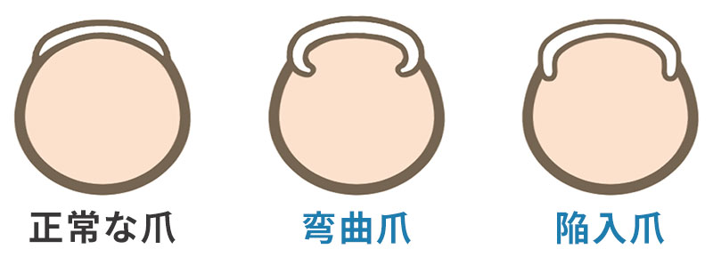 巻き爪とは