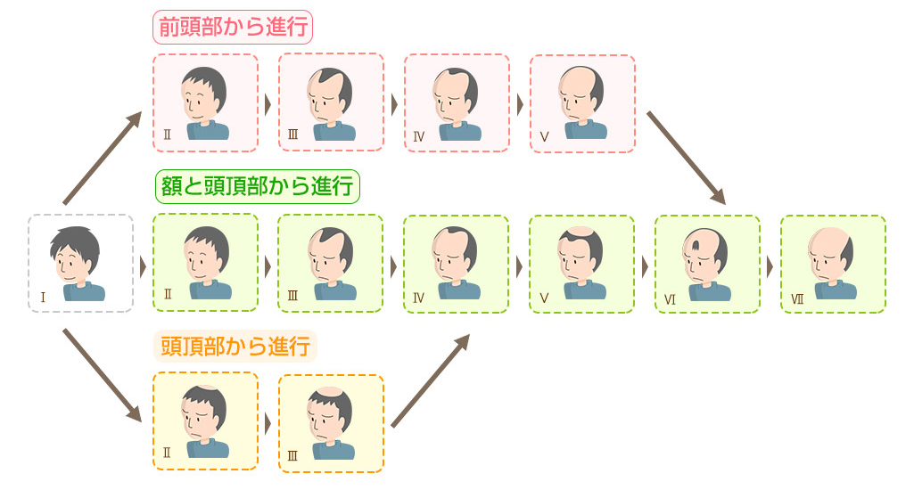 男性の薄毛の進行パターン