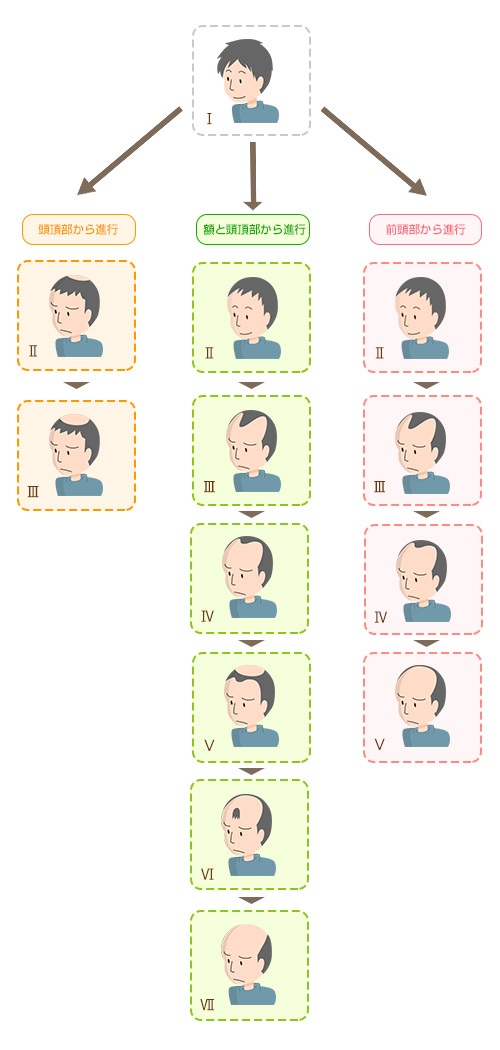 男性の薄毛の進行パターン